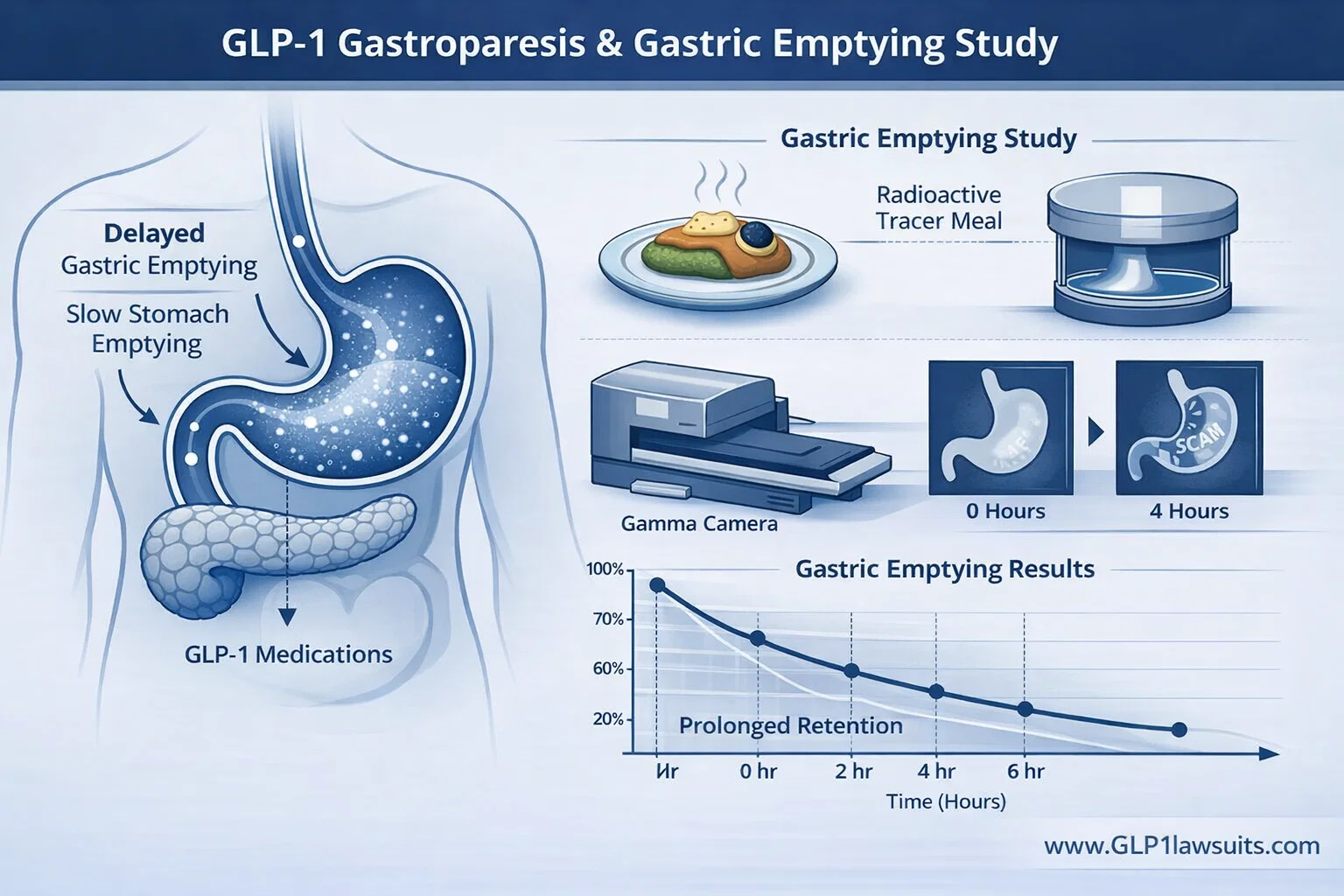 The Gastric Emptying Study: MDL 3094 Requirements for GLP-1 Gastroparesis Claims (2026 Update)